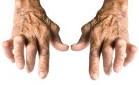 CBD Hanföl und Arthritis